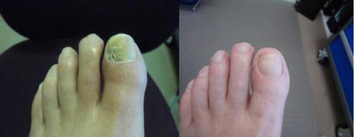 Fotos von Füßen vor und nach der Anwendung von Zenidol-Creme